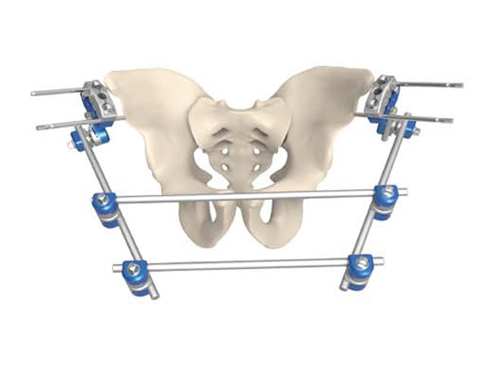 骨盆固定